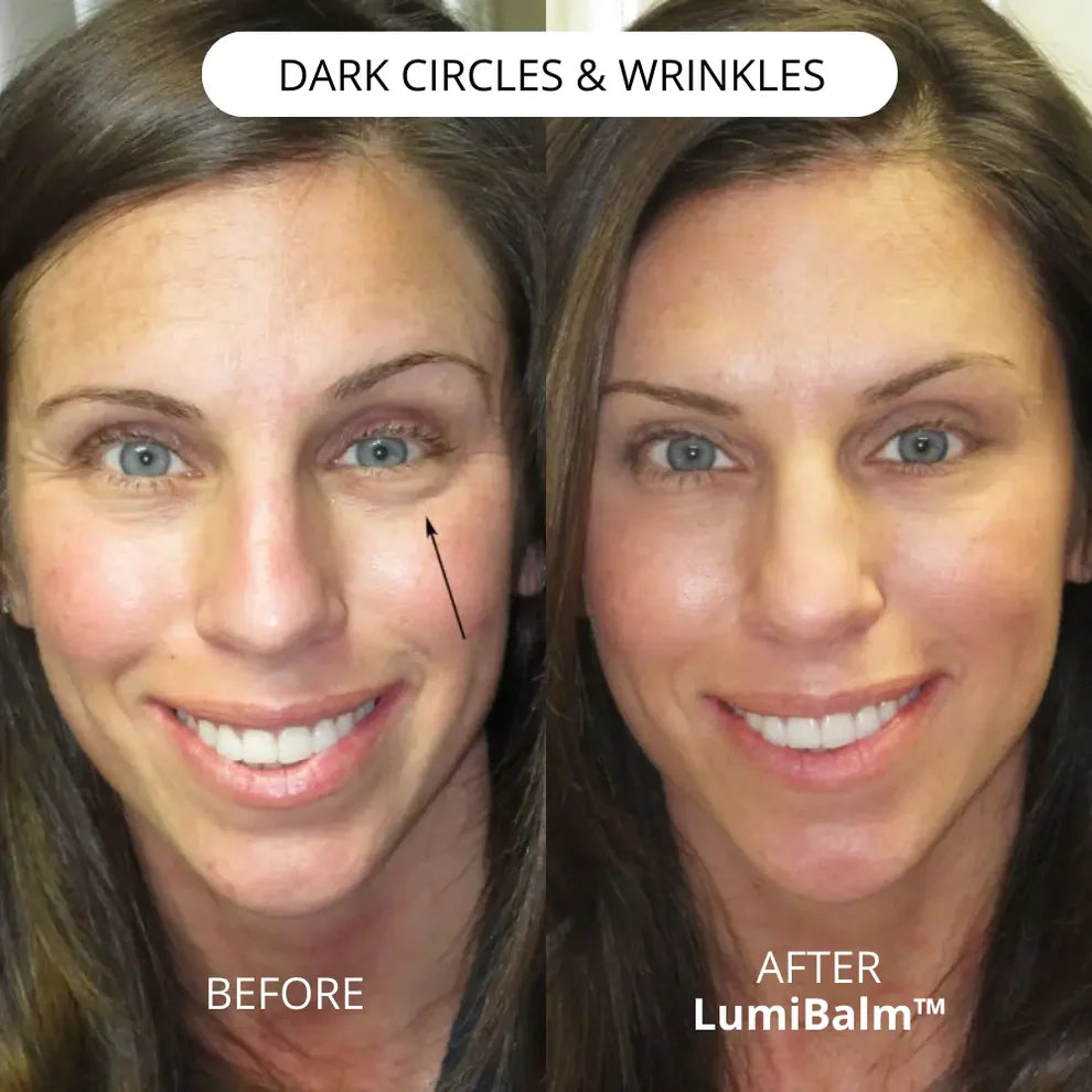 LumiBalm™ lässt Tränensäcke in wenigen Minuten verschwinden